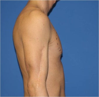 Pectoral Augmentation, Pec Implants before 665744