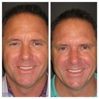 "Brotox"/Botox Before & After Overall Result before 1013845