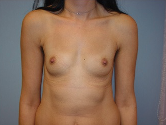 Breast augmentation with breast implants before 259915