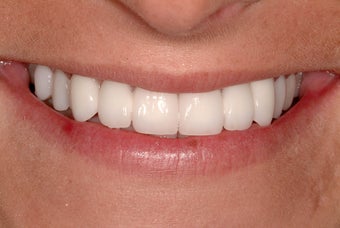 Bridges and Veneers after 207752