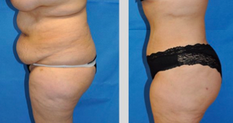 Tummy Tuck before 264078