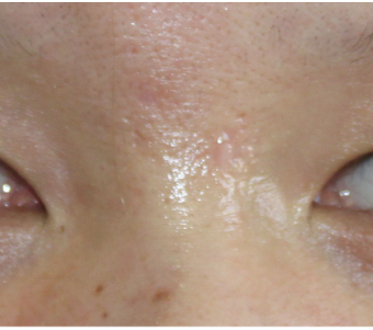 Facial Scar Removal/Treatment after 944169
