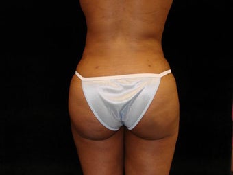 Buttocks Augmentation by Fat Grafting after 159257