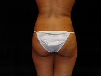 Buttocks Augmentation by Fat Grafting before 159257