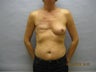 48 year old woman with breast reconstruction