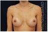 Breast Augmentation