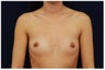 Breast Augmentation