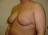 Breast Lift
