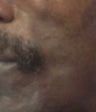 Male Patient Treated with Sculptra