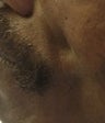 Male Patient Treated with Sculptra