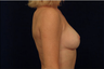 Breast Augmentation