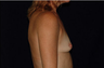 Breast Augmentation
