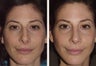 40 year-old female with a complex deviated nasal septum