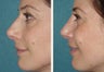 40 year-old female with a complex deviated nasal septum