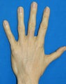 Hand Rejuvenation with Filler