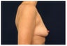 Breast Lift