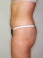 34 year old female undergoes liposuction to lower abdomin