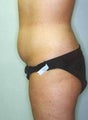 34 year old female undergoes liposuction to lower abdomin
