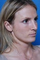 Revision rhinoplasty patient