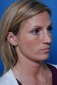 Revision rhinoplasty patient
