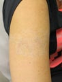 Tattoo Removal