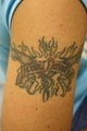 Tattoo Removal