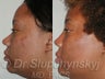 Ethnic Rhinoplasty