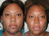 Ethnic Rhinoplasty