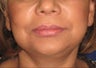 Facelift