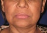 Facelift