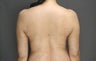 SmartLipo MPX of back and flanks