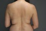 SmartLipo MPX of back and flanks