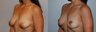 Breast Lift