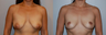 Breast Lift