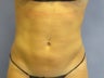 Liposuction: Upper abs, Lower abs, Waist