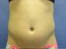 Liposuction: Upper abs, Lower abs, Waist