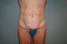 Total Body Lift
