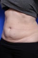 Coolsculpting Before