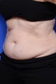 Coolsculpting Before