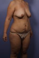 40 yr old Mommy Makeover