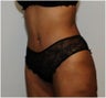 Abdominoplasty