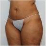 Abdominoplasty