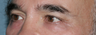 Fraxel Repair Around Eyes Male Patient