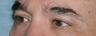 Fraxel Repair Around Eyes Male Patient