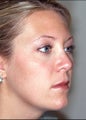 Revision rhinoplasty