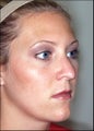 Revision rhinoplasty