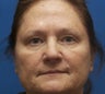 60 year old female with loss of volume in the cheek region