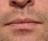 26 Year Old Treated For Large and Chapped Lips