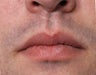 26 Year Old Treated For Large and Chapped Lips