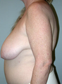 Breast Lift